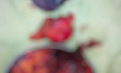 Karnından 2 kilo 200 gram ağırlığında tümör çıkarıldı