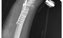 Köpeklerin saldırısından kaçarken düştü, kolu kırıldı