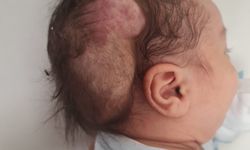 Talha bebeğin dünyada nadir görülen beyin tümörü, 4 saatlik operasyonla alındı