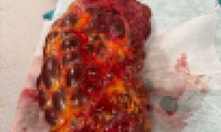 Karın ağrısı ve şişkinlik şikayetiyle hastaneye gitti; 8 kiloluk böbreği ameliyatla alındı