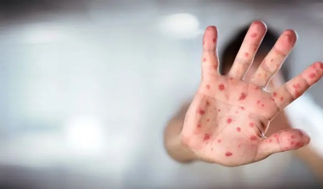 ABD'nin Texas eyaletindeki kızamık salgınında vaka sayısı 624'e yükseldi