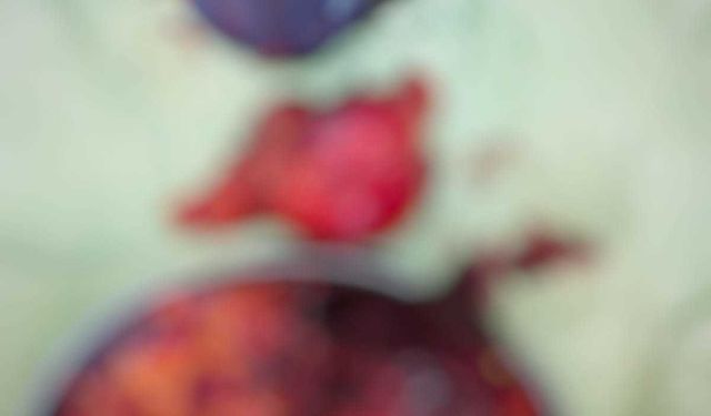 Karnından 2 kilo 200 gram ağırlığında tümör çıkarıldı