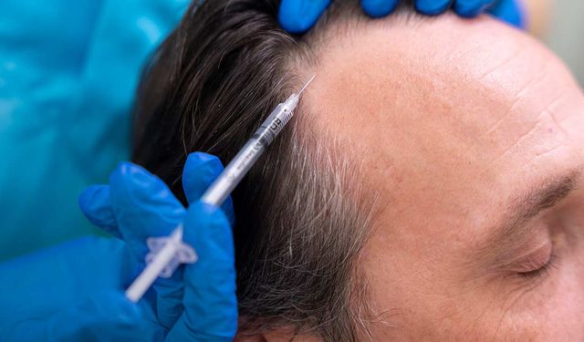 Kelliğe Çözüm mü? Yeni İlaç Saçları %539 Artırdı