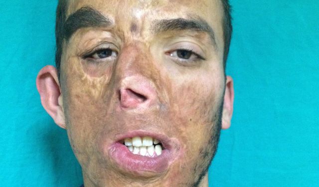 İlk yüz nakilli Uğur Acar, hayata 14 yıldır başka bir yüzle bakıyor