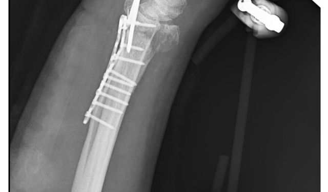 Köpeklerin saldırısından kaçarken düştü, kolu kırıldı