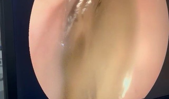 Kedinin midesindeki vantuz, 4 yıl sonra fark edilerek çıkarıldı