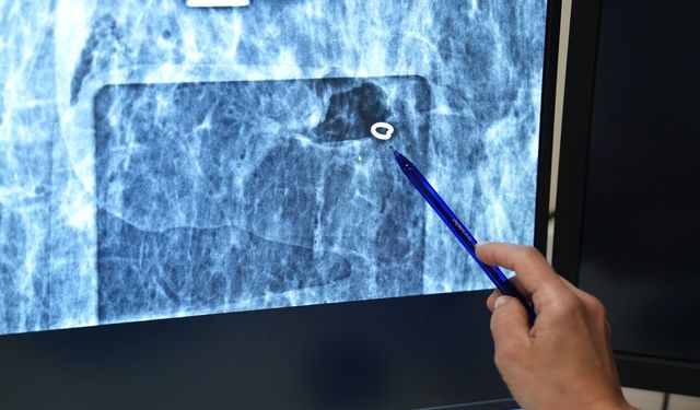'Ele gelmeyen meme kitleleri milimetrik hassasiyetle tespit ediliyor'