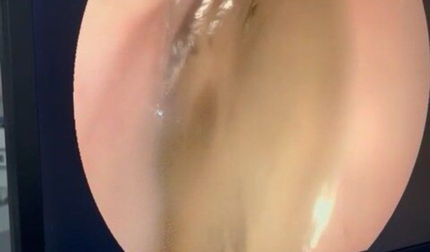 Kedinin midesindeki vantuz, 4 yıl sonra fark edilerek çıkarıldı