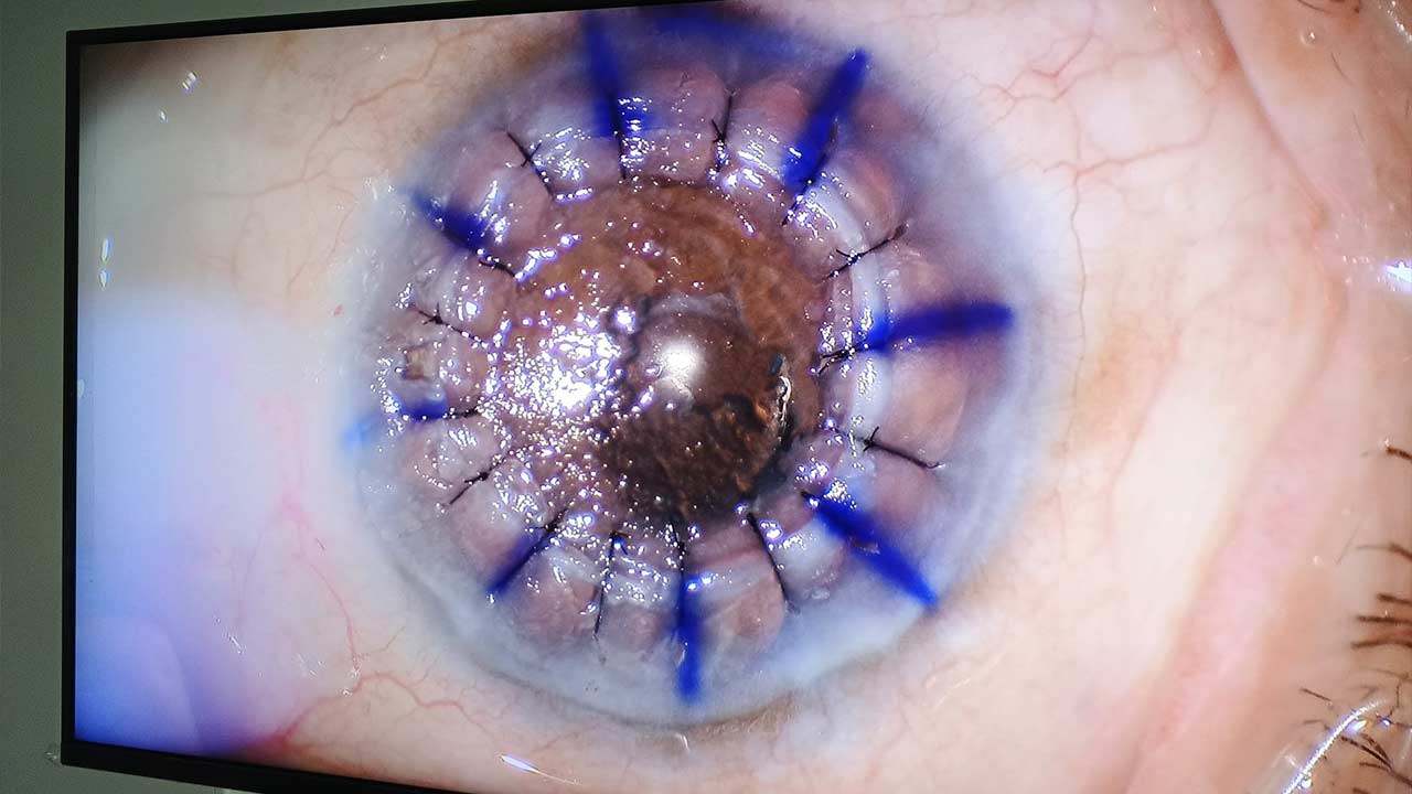 Samsun Kornea Nakli 4